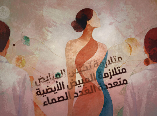 علاج متلازمة تكيس المبايض